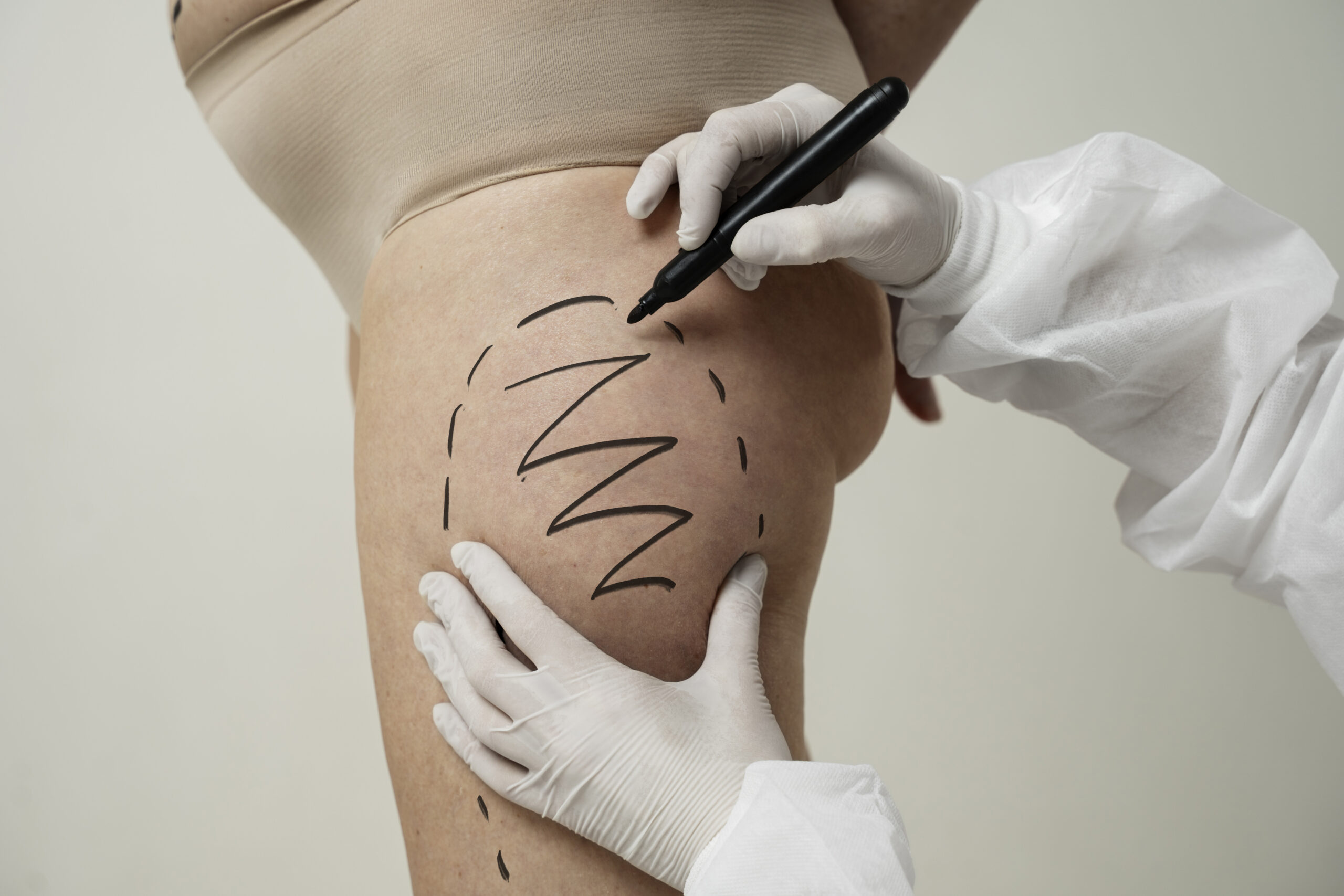 side-view-woman-with-marker-traces-leg