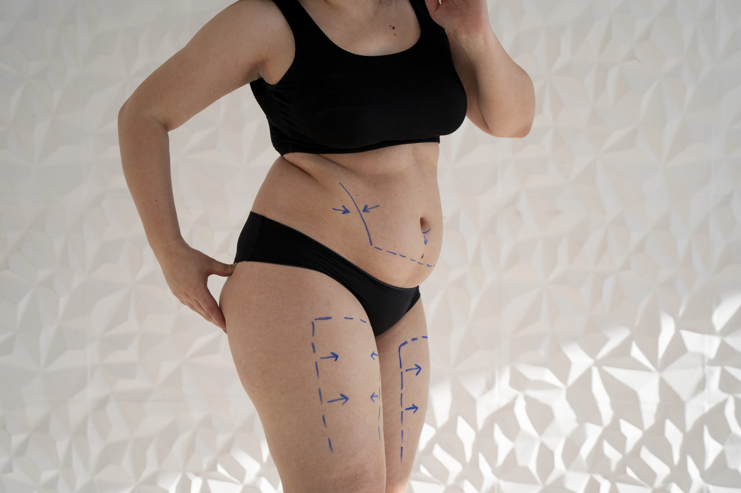 woman-s-body-with-marker-traces-side-view